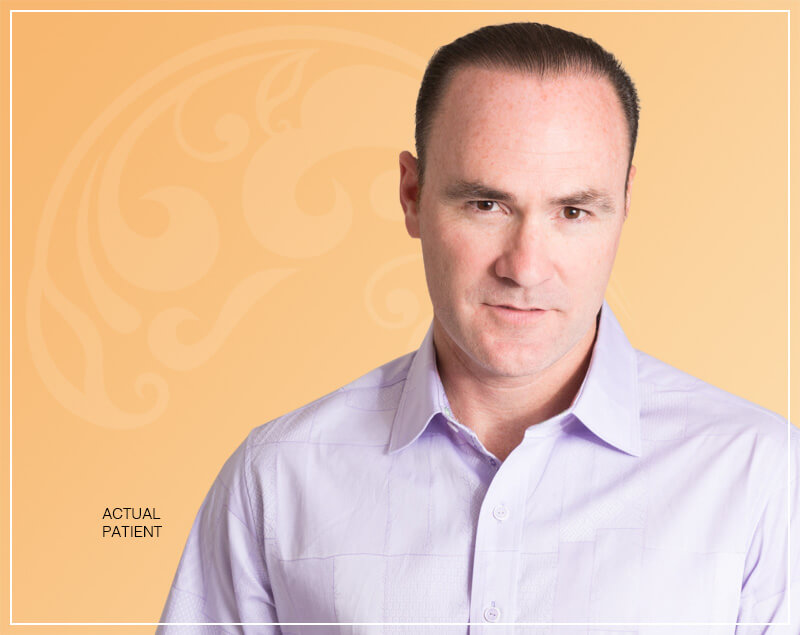 Consultation with Dr. Palladino to prepare for male hair restoration surgery