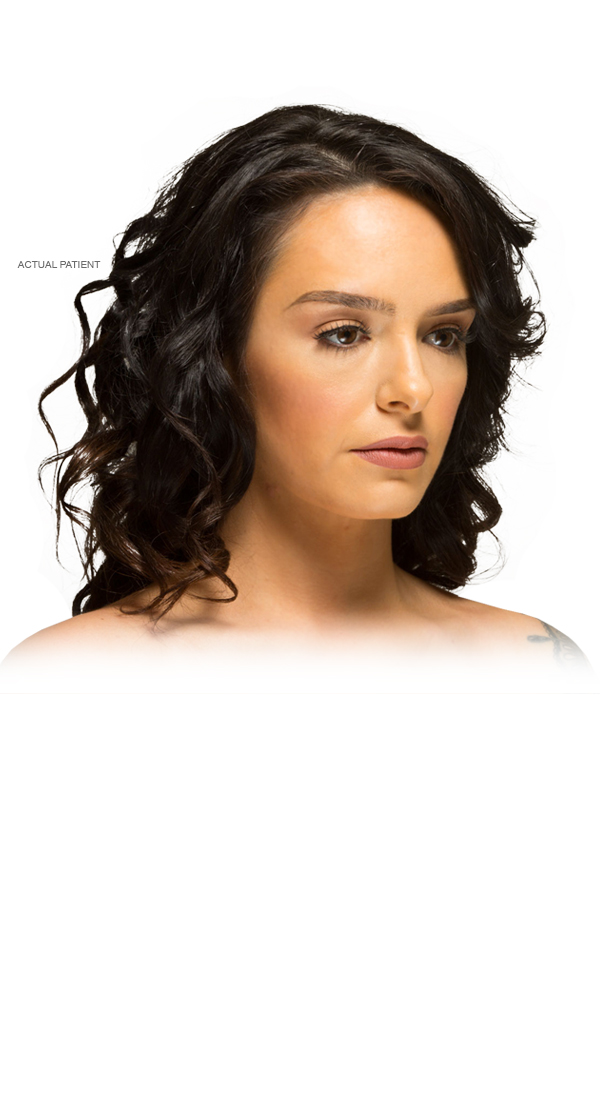 Fat injections facial rejuvenation, Dr. Palladino, Fort Lauderdale