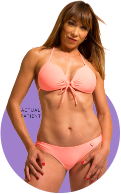 Tummy tuck surgery (abdominoplasty)