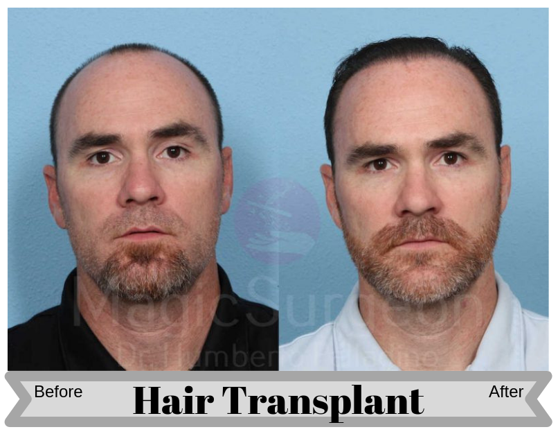 HAIR-TRANSPLANT-PATIENT-2A-800x534-Blog_BA_Img