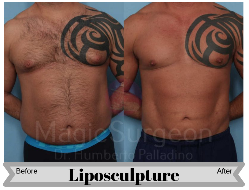 MALE-HD-LIPOSCULPTURE-PATIENT-1A-800x534-Blog_BA_Img