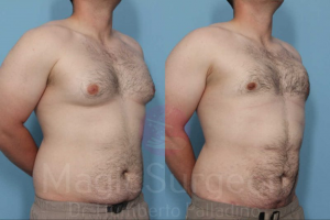 Palladino Male Breast Reduction Patient Before and After photos