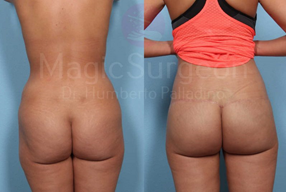Muscle Flap Buttock Lift Before and After Photos