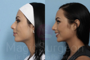 Rhinoplasty Surgeon Austin