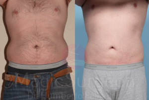Liposuction patient by Dr. Palladino
