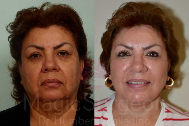 FACELIFT-PATIENT-1A-facelift Magic Surgeon