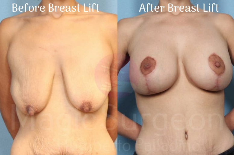 BREAST-LIFT-PATIENT-1A-Blog-BA-IMG