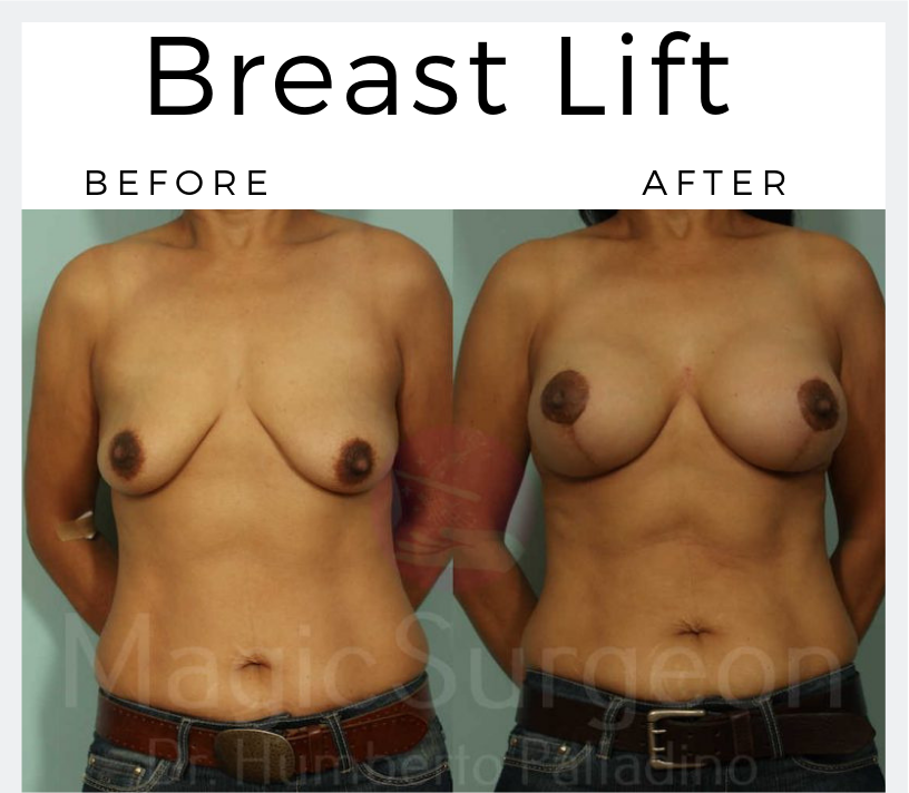 Breast-Lift-Patient-4a-Blog-BA-Img