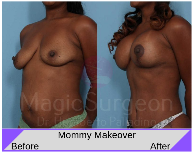 Mommy Makeover Before and After Photos